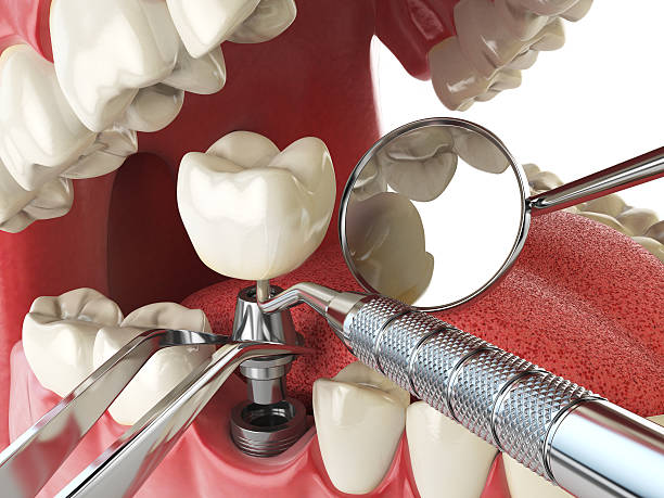 Emergency Dental Filling Replacement in UT